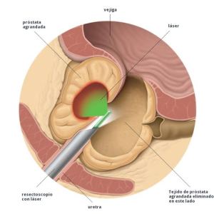 Greenlight de Próstata