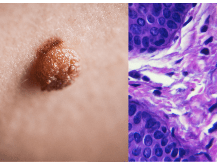 VPH ( Virus del Papiloma&nbsp;Humano)